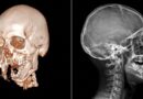 Reconstruye IMSS en Chiapas rostro de adolescente tras accidente de motocicleta