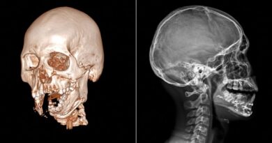 Reconstruye IMSS en Chiapas rostro de adolescente tras accidente de motocicleta